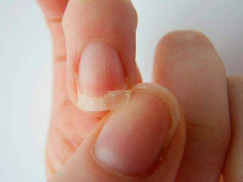Ảnh minh họa móng tay yếu và mỏng do sử dụng sơn móng tay kkv không đúng cách