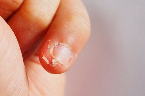 Ảnh móng tay chân của trẻ bị hư tổn, có dấu hiệu bệnh lý cần được chăm sóc kịp thời
