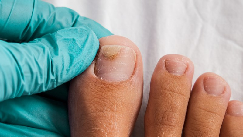 Bàn chân với móng chân bị bong tróc nhẹ do chấn thương