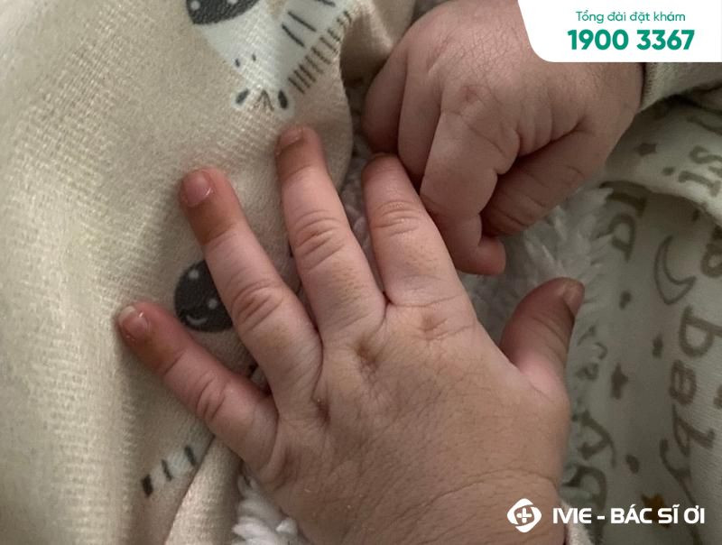 Bàn tay bé với các ngón tay có dấu hiệu xanh tím dưới móng, biểu hiện trẻ bị thâm dưới móng tay.