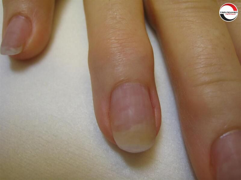 Bàn tay có đốm trắng trên móng, thể hiện ý nghĩa phong thủy khi xem bói điềm trắng trên móng tay.