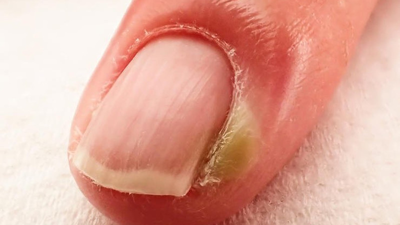 Bàn tay với ngón tay cái bị sưng đỏ ở khóe móng, biểu hiện của chín mé