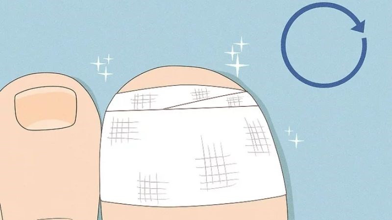Băng ngón chân bằng băng y tế sau khi loại bỏ móng hư