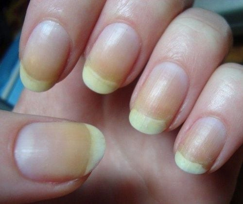 Bất thường hình thái móng tay về màu sắc có thể do nhiều nguyên nhân