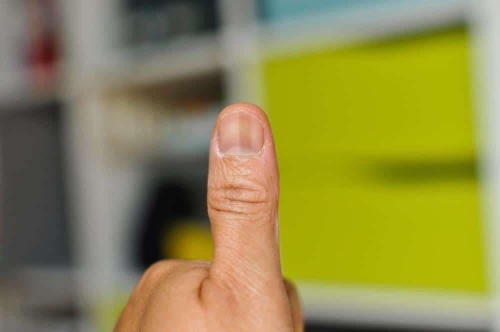 Bệnh lý về gan có thể ảnh hưởng đến màu sắc của móng, gây sọc nâu