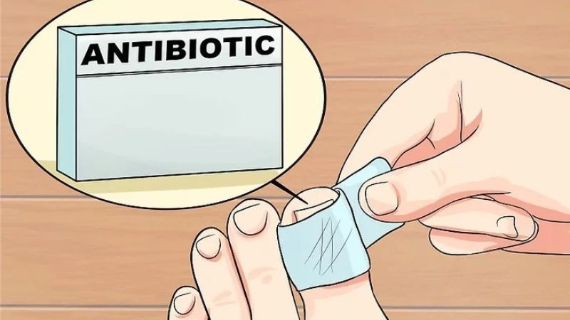 Bôi thuốc kháng sinh là một phần quan trọng của cách dưỡng móng chân sau tổn thương