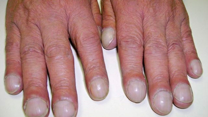 Các biểu tượng bệnh lý khác nhau liên quan đến nguyên nhân gây ra móng tay dùi trống, bao gồm bệnh phổi, tim và tiêu hóa.