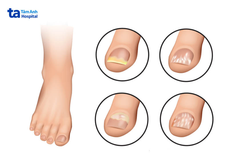 Các dấu hiệu bị nấm móng chân cần chú ý sớm