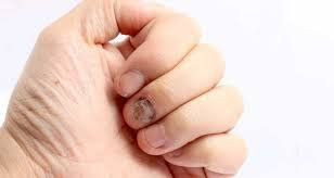 Các dấu hiệu móng tay bị tổn thương, đổi màu cần lưu ý để tránh tình trạng móng tay bị phồng lên hoặc nặng hơn.