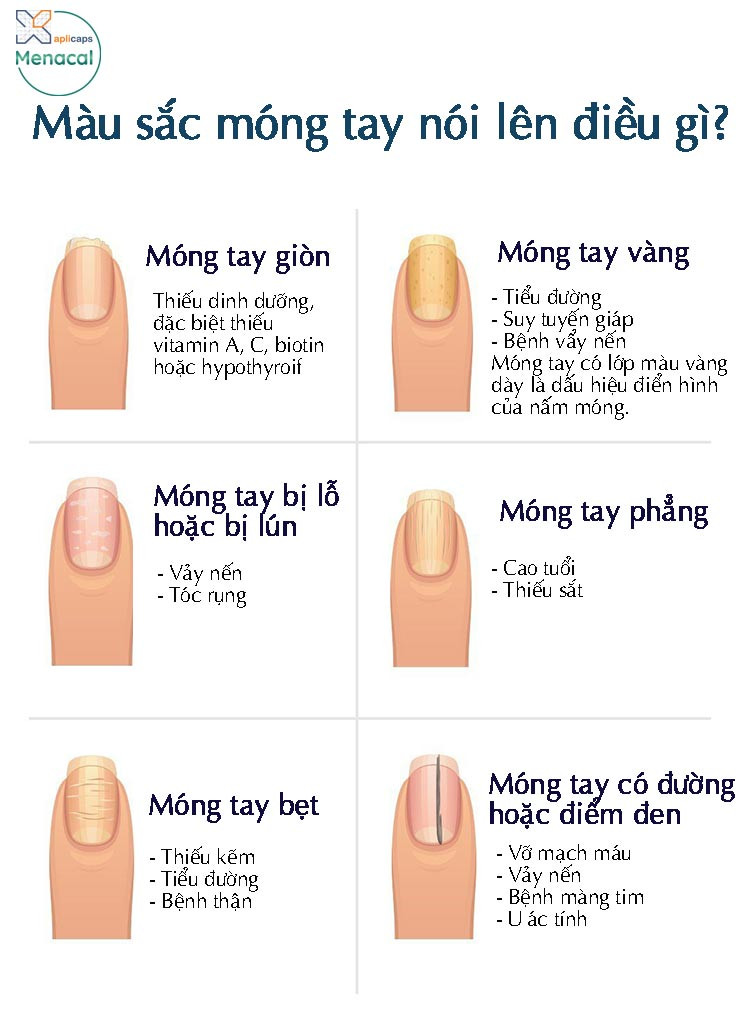 Các màu sắc và hình thái móng tay bất thường cảnh báo sức khỏe