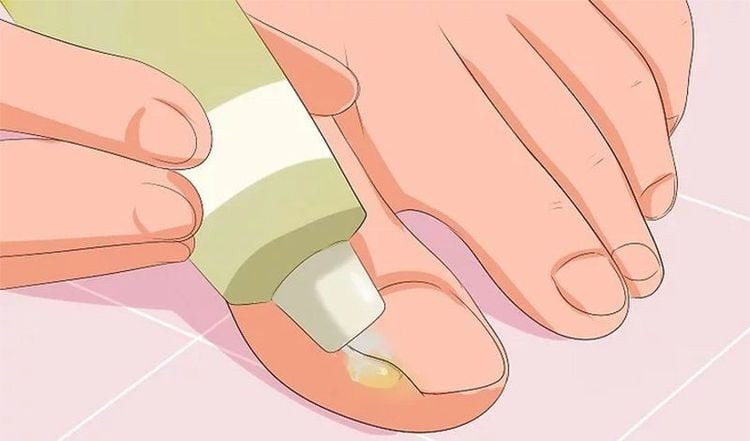 Cách bôi thuốc mỡ kháng sinh để điều trị móng chân mọc ngược không đâm vào thịt