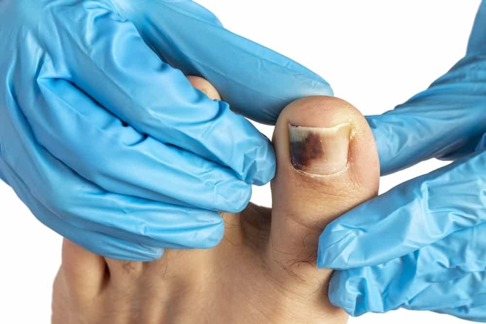 Cách chườm đá giảm sưng và đau cho tụ máu bầm ở móng chân
