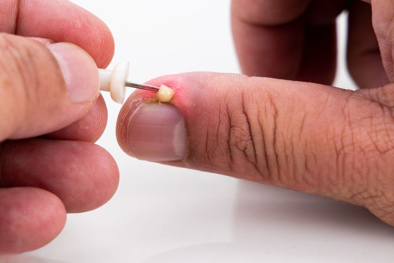 Cách vệ sinh và sát khuẩn khoé móng tay bị mưng mủ tại nhà