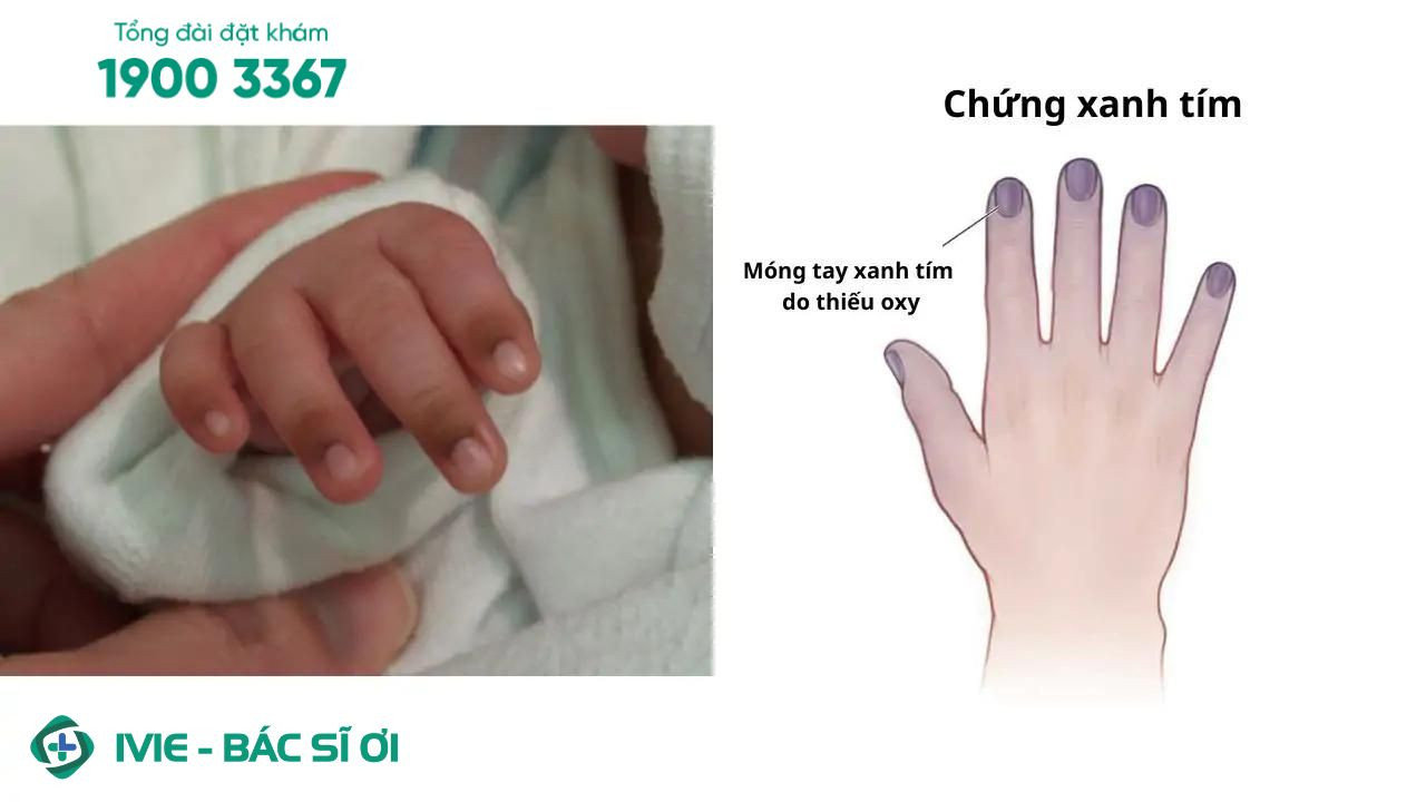 Cận cảnh bàn tay nhỏ của bé có biểu hiện tím tái dưới móng, cho thấy tình trạng trẻ bị thâm dưới móng tay.