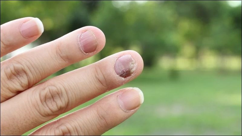 Cắt ngắn móng chân bị bong là một phần quan trọng của quá trình chăm sóc