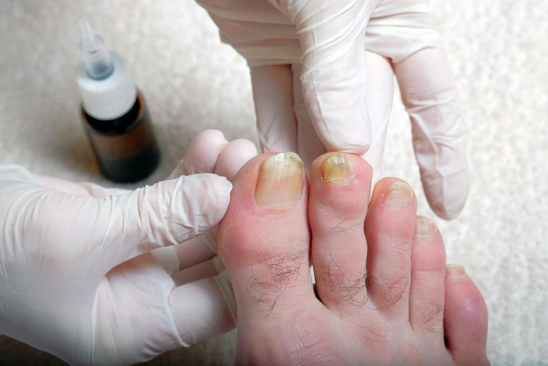Chăm sóc móng chân bầm tím và theo dõi để phục hồi tốt nhất