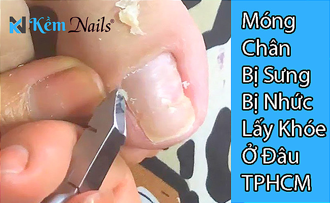 Chân bị sưng mủ nhức do lấy khóe móng chân sai cách