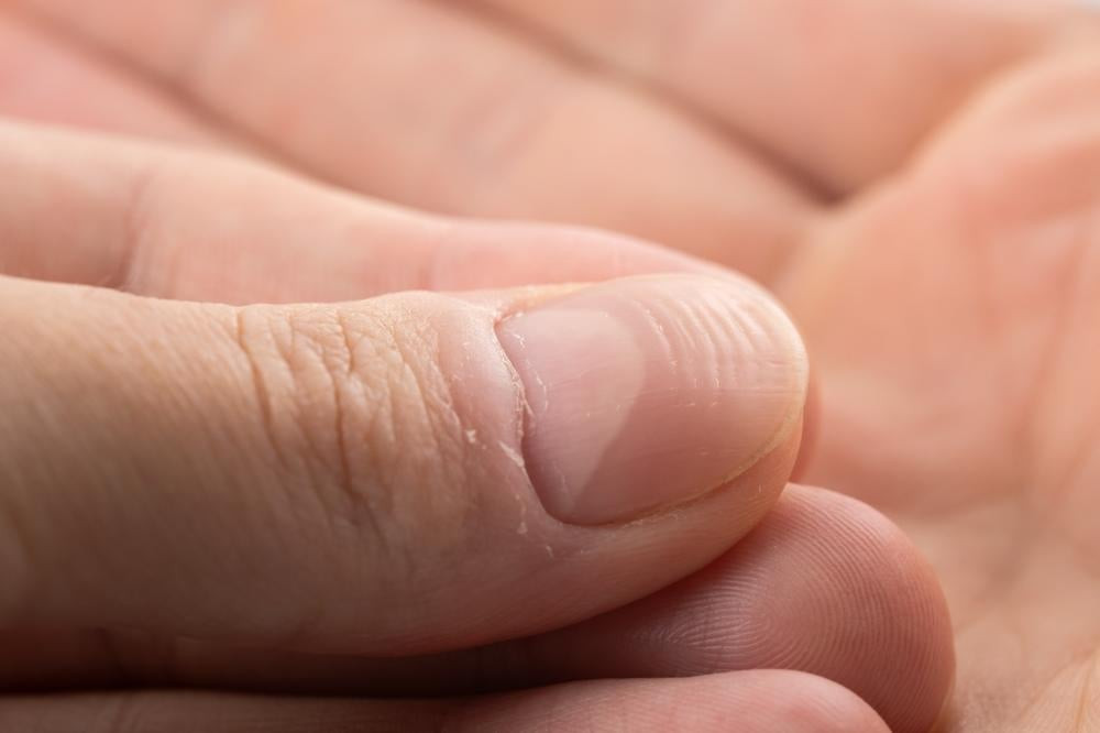 Chế độ dinh dưỡng không đầy đủ gây ra móng tay có sọc và các vấn đề về móng khác.