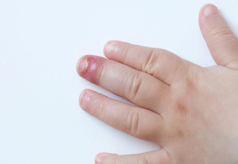 Chín mé gây sưng tấy và viêm nhiễm ngón tay, tiềm ẩn nguy cơ tụt móng