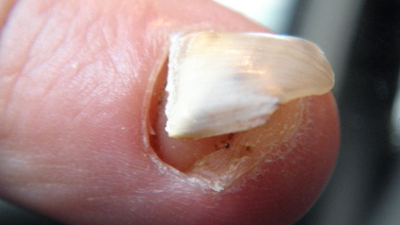 Cố định và bảo vệ khi móng tay bị bong