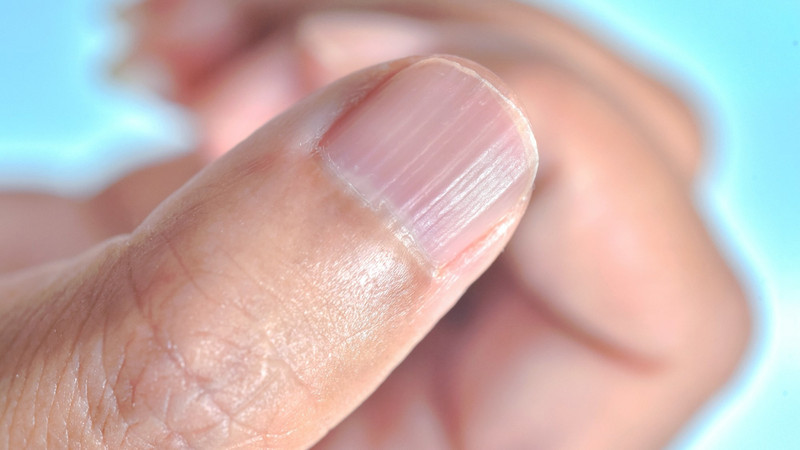 Móng Tay Bị Sần Gợn Sóng Là Bệnh Gì? Giải Mã Dấu Hiệu Sức Khỏe Dấu hiệu móng tay bị sần gợn sóng, mô tả các rãnh trên bề mặt móng tay.