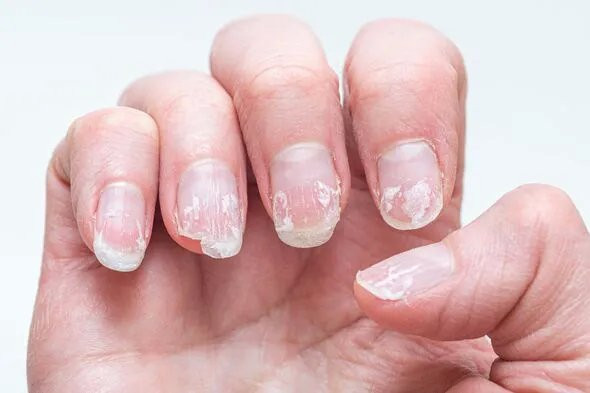 Dấu hiệu móng tay giòn dễ gãy và nguyên nhân từ sức khỏe