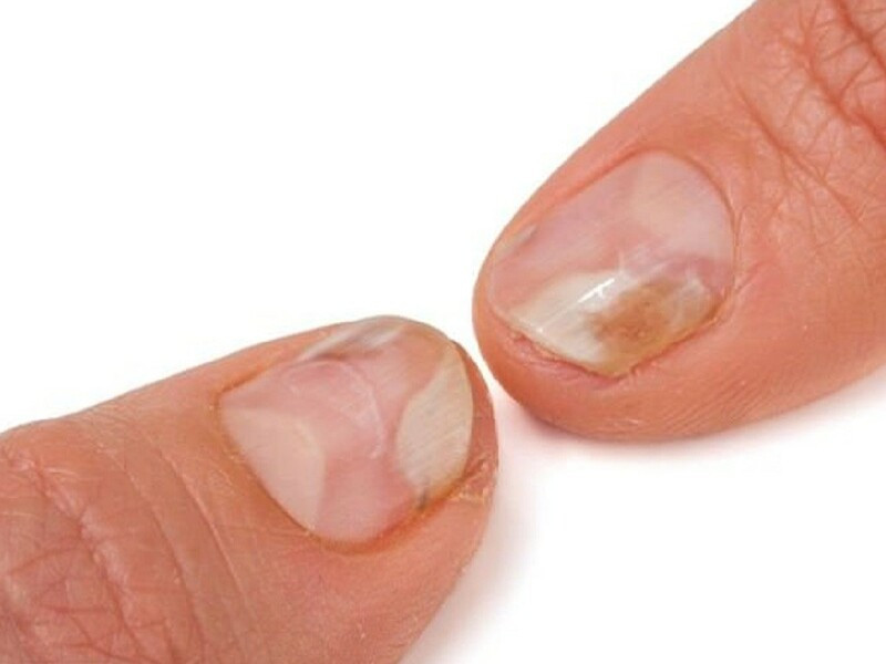 Điều trị móng tay bị nước ăn cần sự kiên trì