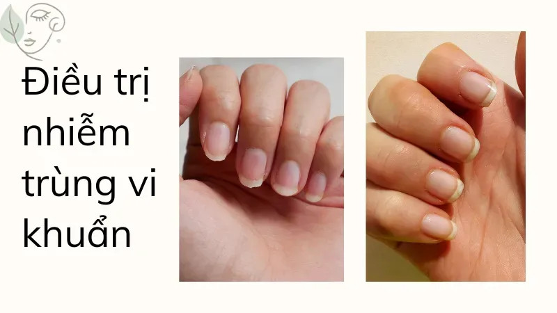 Điều trị nhiễm trùng vi khuẩn quanh móng tay