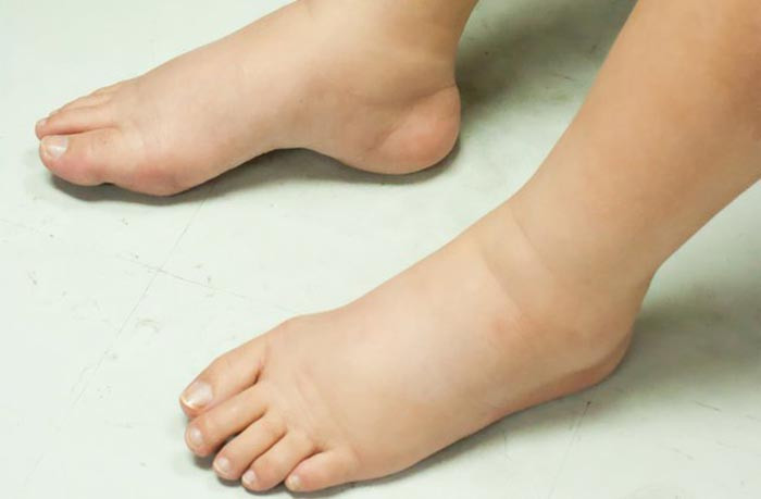 Hàm lượng magie và canxi trong nho móng tay giúp giảm phù nề, bầu ăn nho móng tay được không