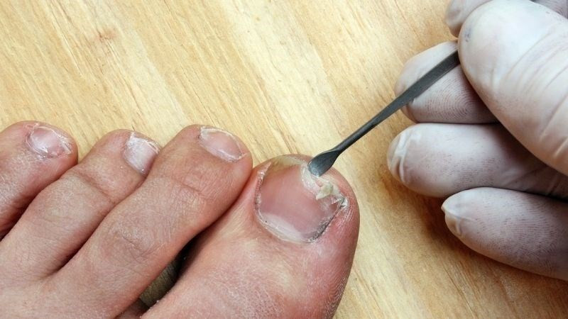 Hình ảnh bàn chân với móng chân cái chỉ bị bong tróc nhẹ có thể tự xử lý