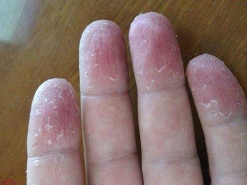 Hình ảnh bàn tay bị bong tróc da tay do rửa tay quá nhiều và tiếp xúc hóa chất