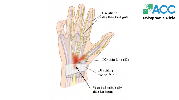 Tê Đầu Móng Tay: Nguyên Nhân, Cách Chẩn Đoán & Điều Trị Hiệu Quả hình ảnh bàn tay bị tê đầu móng tay do hội chứng ống cổ tay