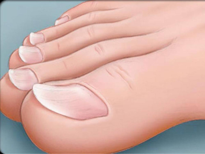 Hình ảnh cận cảnh móng chân bị vểnh, dấu hiệu cảnh báo sức khỏe ở người có móng chân vểnh