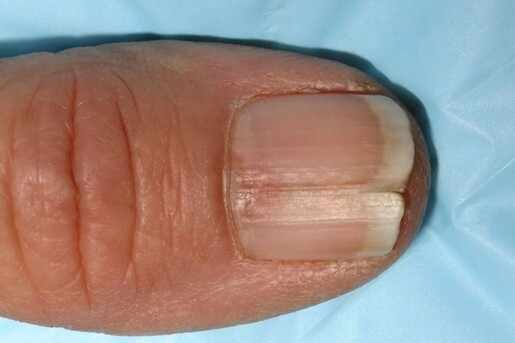 Hình ảnh cận cảnh móng chân cái bị chẻ đôi theo chiều dọc, biểu hiện tổn thương rõ ràng.