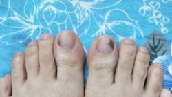 Hình ảnh cận cảnh móng chân xuất hiện vết đen, cần phân biệt với móng chân màu xanh lá cây và các tình trạng khác