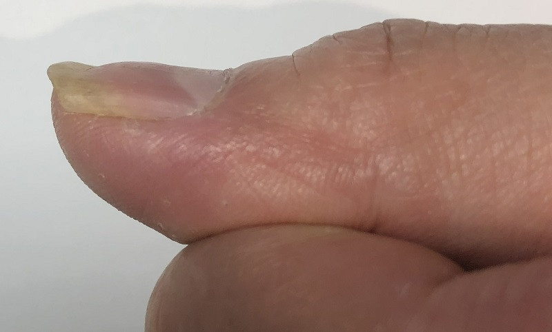 Hình ảnh cận cảnh móng tay bị lõm vào điển hình