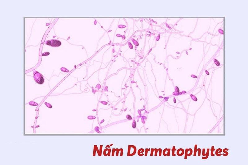 Hình ảnh cận cảnh nấm dermatophytes gây tổn thương móng, một nguyên nhân phổ biến khiến móng chân bị nứt ở giữa