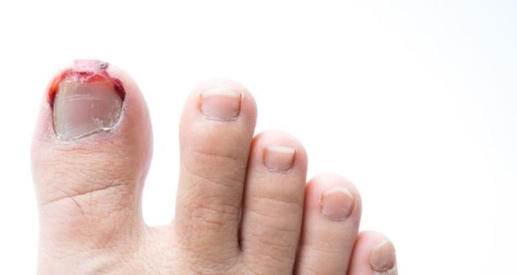 Hình ảnh minh họa các nguyên nhân khiến móng chân mọc ngược đâm vào thịt