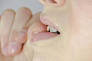 Hình ảnh minh họa thói quen cắn móng tay gây tổn hại, làm móng yếu và khó cứng cáp