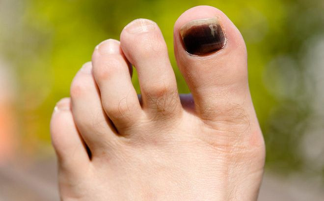 Hình ảnh móng chân bị bầm tím cần được điều trị