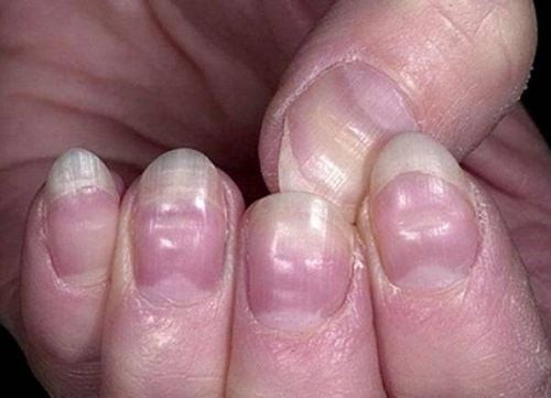 Hình ảnh móng chân bị vảy nến với những vết lõm đặc trưng