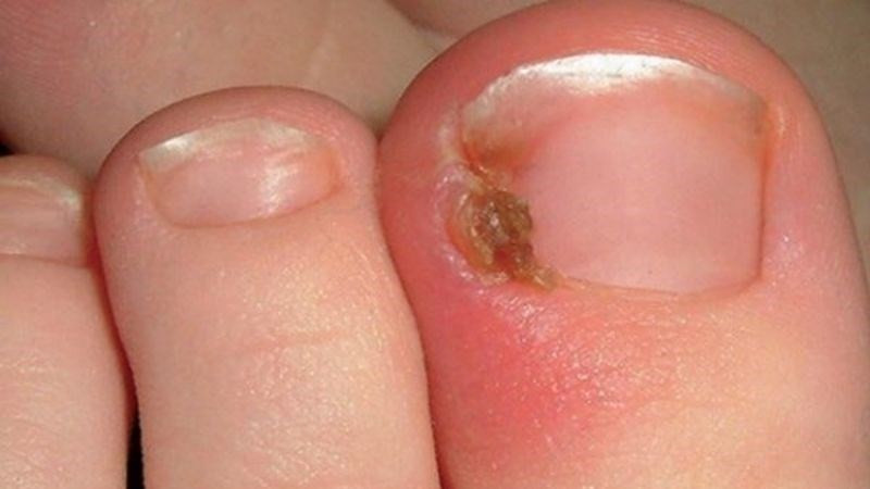 Hình ảnh móng chân cái bị hư nhiễm trùng nếu không được điều trị kịp thời