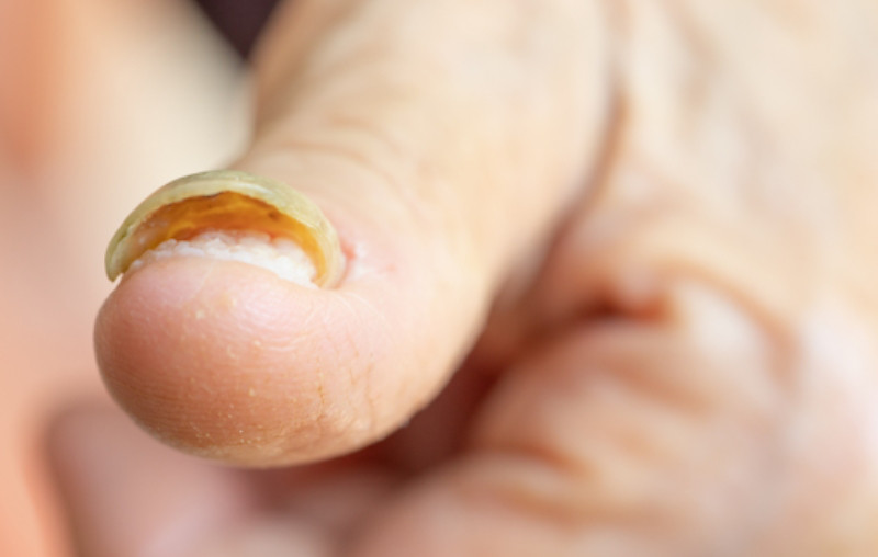Hình ảnh móng tay bị bật gây đau nhức và chảy máu