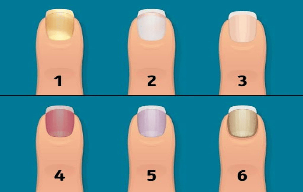 Hình ảnh móng tay bị đen đang được kiểm tra, biểu thị cần thăm khám y tế