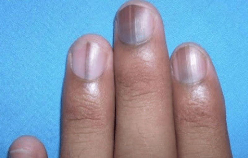 Hình ảnh móng tay bị đen do chấn thương hoặc tác động vật lý