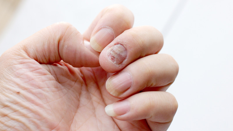 Hình ảnh móng tay bị nấm với màu vàng, bong tróc do nhiễm trùng, một rủi ro khi bầu có được làm móng tay không an toàn.
