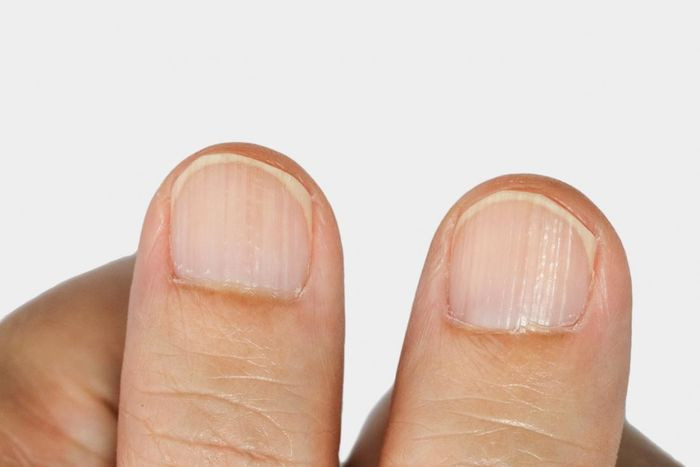 Hình ảnh móng tay bị sọc dọc nổi rõ, thường gặp khi móng chân bị sọc dọc do lão hóa