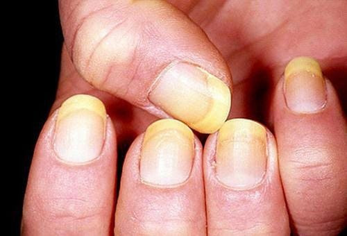 Hình ảnh móng tay bị vàng, một dấu hiệu khác biệt với móng tay trong suốt, cho thấy các vấn đề về sức khỏe móng