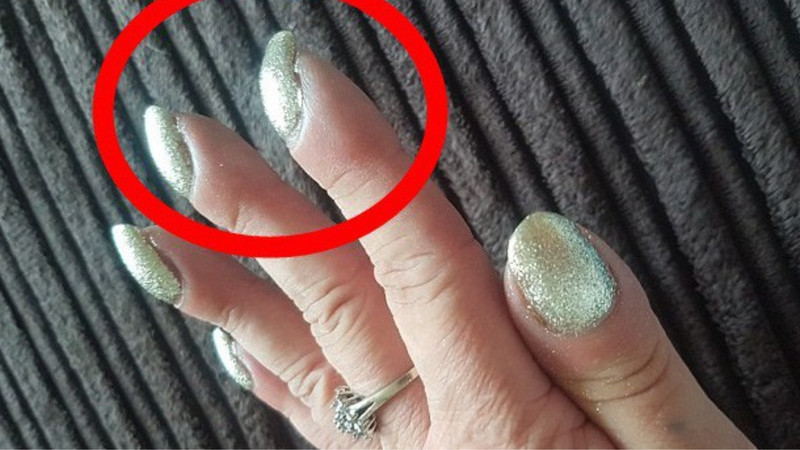 Hình ảnh móng tay cụp xuống bất thường, gợi ý về ý nghĩa sức khỏe tiềm ẩn