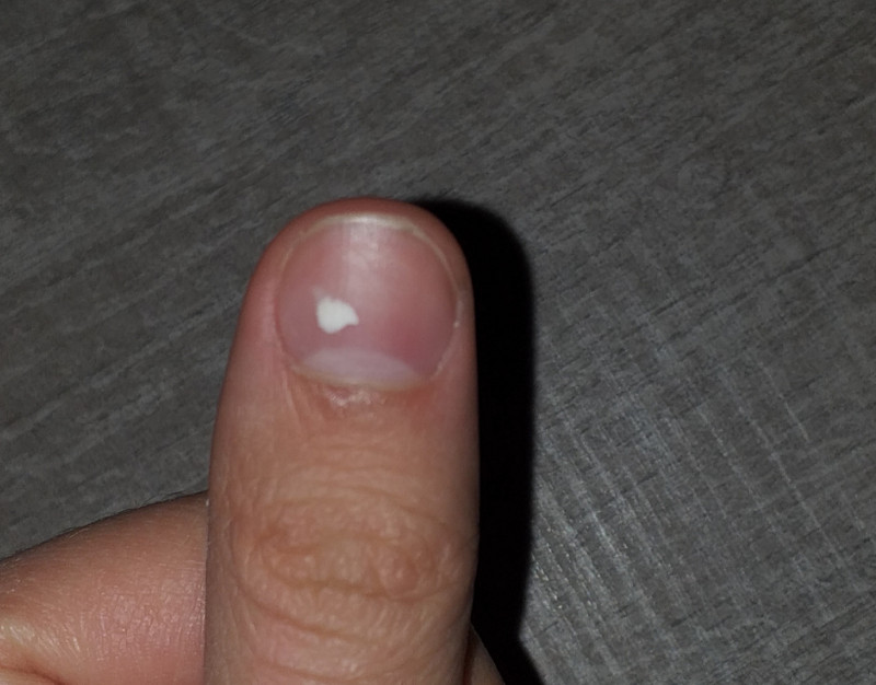 Hình ảnh móng tay trẻ có vệt trắng ngang và các đốm trắng biểu hiện thiếu chất